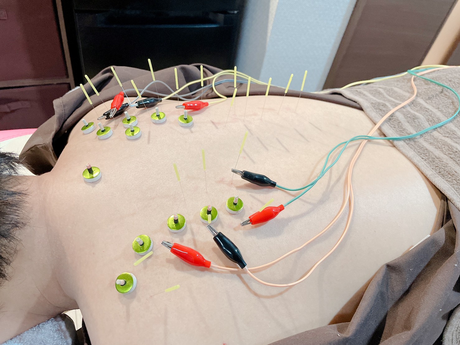 電極を背中に通している様子