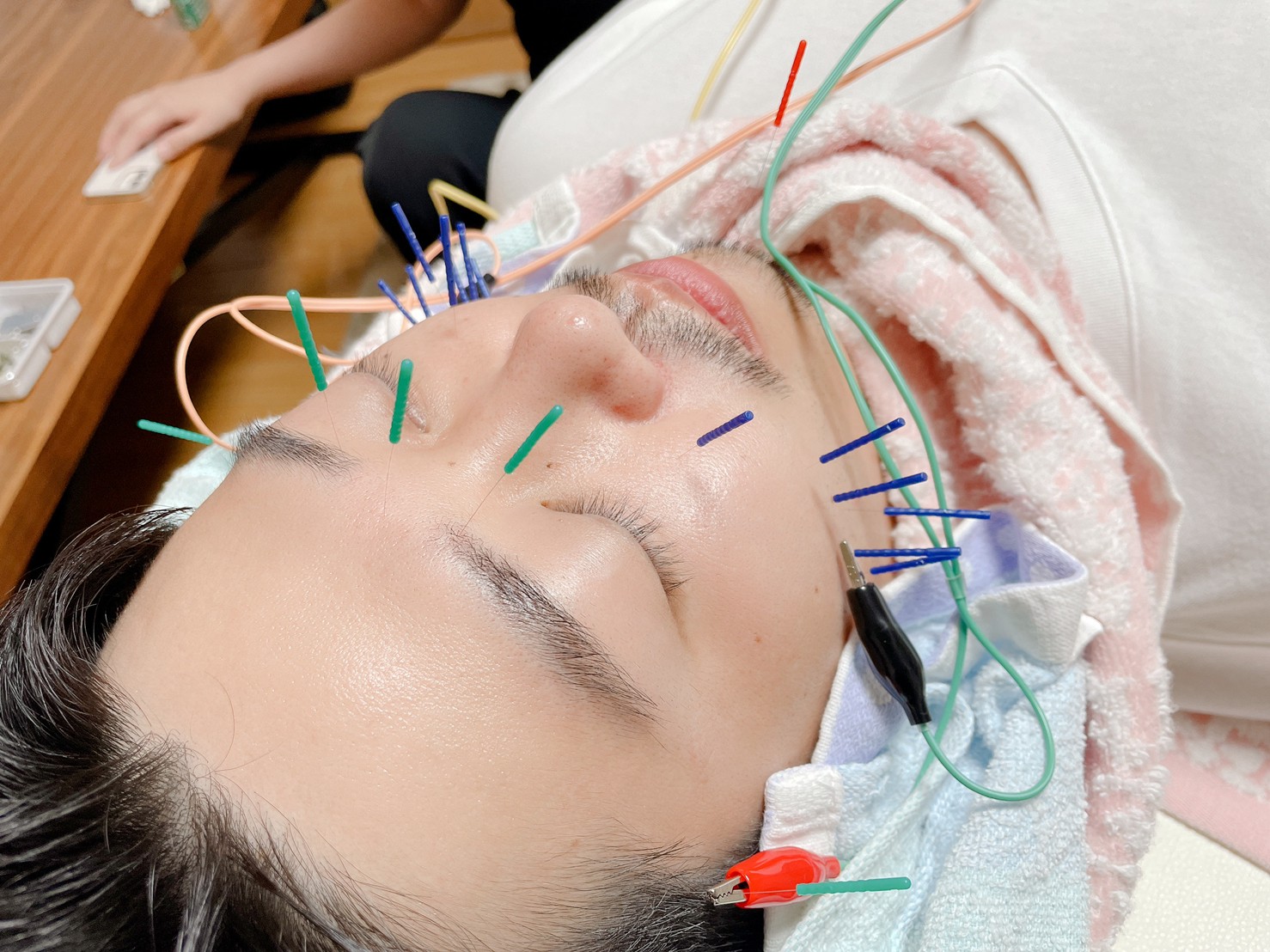 顔に美容針をしている様子