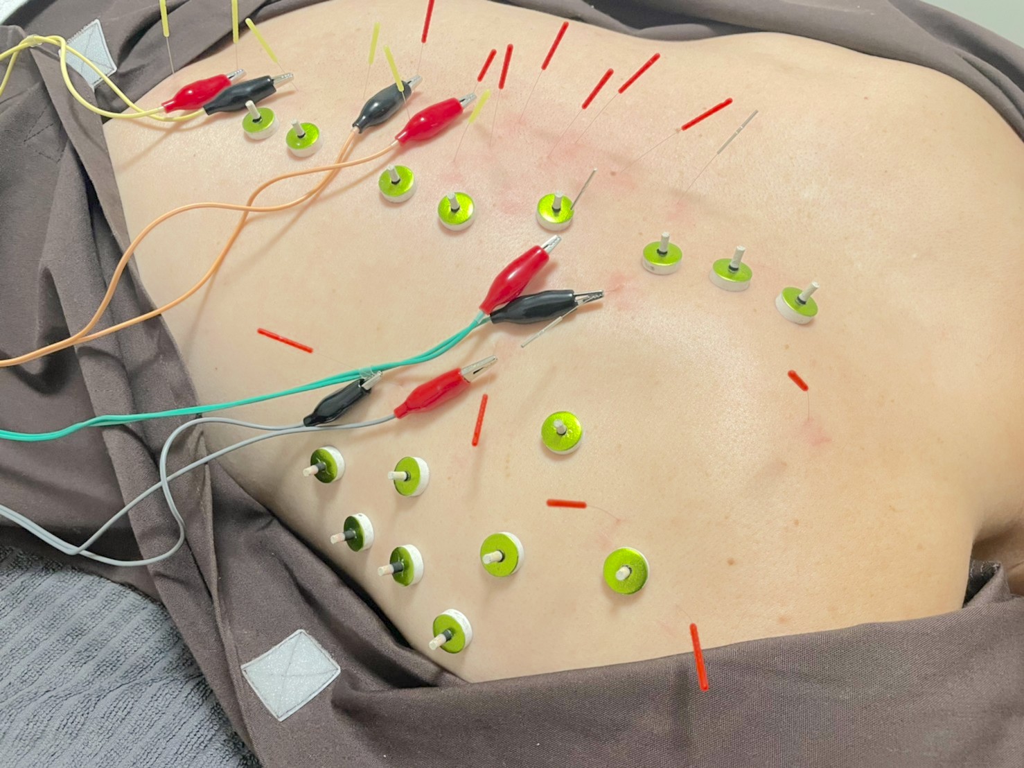 背中に鍼灸や針をしている様子